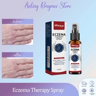South Moon Psoriasis Relief Spray 30ml Eczema Therapy Spray Remover Itchy Skin Psoriasis
