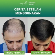 Penumbuh Rambut Botak Dan Rontok Newmo Penumbuh Rambut Cepat Pria