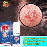 Seborrheic Dermatitis Spray 30ml Scalp Treatment Scalp Psoriasis Anti Dandruff Ubat Kulit Kepala Ber