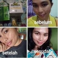End_pekan Effective Package Acne Removal 100% Bandel