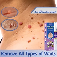 Warts Flat Eliminate Wart Pen Liquid Hand Foot Warts Remove Filiform Flat Warts Condyloma Acuminatum