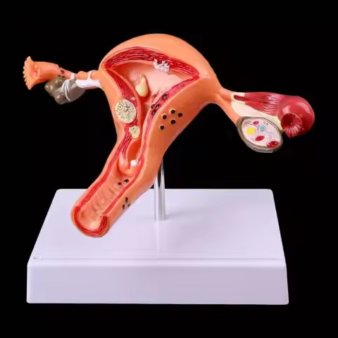 Medical Anatomy Model Pathological Uterus Ovary Cross Section Study Tool Free Shipping