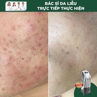 Điều Trị Mụn Bằng IPL (F-AC) Thẩm mỹ không xâm lấn