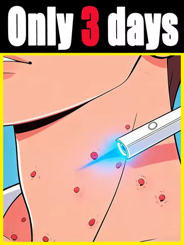 Blue light wart removal tools to make your life better.