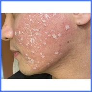 ∈ ✶ ∰ TCA Peel/Cross Solution 100% 15ml