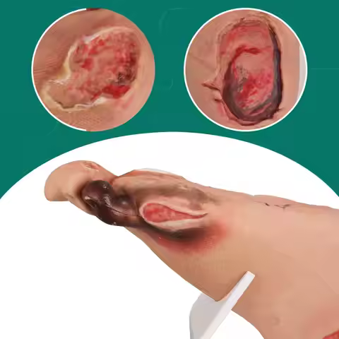 Ultrassist Diabetic Foot Ulcer Model Set, Mild & Severe Stages