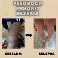 MEDIHERBS GOLD OIL UBAT EKZEMA|ORIGINAL HQ |PROMOSI 🔥 MGO|Mediherbs Gold Oil Merawat Gatal Kurap Ekz