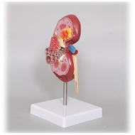 F&H 1.5x Human Kidney Anatomy Model Medical Teaching & Biology Learning Tool Kidney Model with Patho