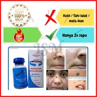 Swiss Paris Wart Mole Skin Tag Remover Fast Effective Safe Solution for Wart Removal Mole Treatment 