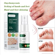 FUNGUS SPRAY Psoriasis Eczema fungal Treatment Spray Athlete Foot Hand ringworm Dermatitis Antibacte