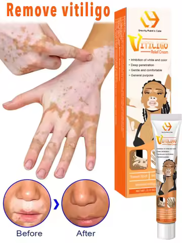 Vitiligo Ointment Remove Ringworm White Spot Gel Removal Skin Vitiligo Eliminate Vitiligo External S