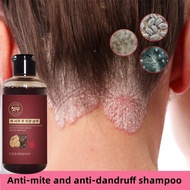 Anti-dandruff shampoo 300ml Shampoo dandruff shampoo nizoral anti dandruff shampoo  Anti-dandruff/An