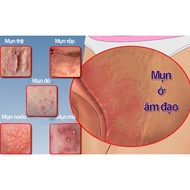 Herbal Topical Treatment to clean and smooth itching, herpes, blisters, and red spots grow in girls 