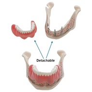 Dental Mandibular Implant Model Detachable Dental Teaching Model Dental Instrument