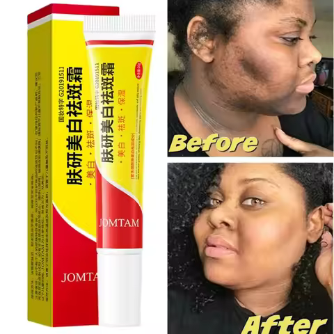 Face Brightening Cream Niacinamide Reduce Chloasma Melasma Melanin Fade Fine Lines Lighten Dark Skin