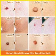✿ ▬ ✹ Warts remover original Mole remover Skin tag remover Removal freckle and melanin spots