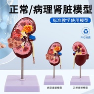 Human Kidney Disease Model System Human Body Model Organ Model Model Anatomy Communication Urinary A