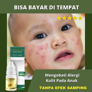Obat Alergi Kulit Pada Anak HERBAL - Eksim Kering Eksim Basah Ruam Pada Kulit Herpes Luka Lecet Gata