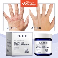 120g Anti-Itch Skin Cream: Safe and Natural Relief for Itching, Eczema, Peeling, Redness, and Rashes