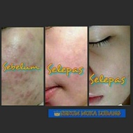 💯 ORIGINAL ~SERUM MUKA LUBANG ,RAWAT MASALAH KULIT MUKA