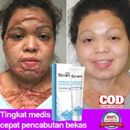 scar cream acne scar acne scar treatment scar removal 20g Proliferative scars Burn scars Keloid fadi