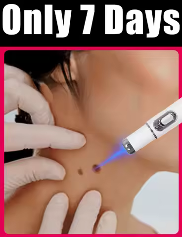 Blue Light Pen Maximum Strength Common and Plantar Wart Falling off warts care tool