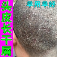 Scalp Long Dry Dandruff Itchy Dry Scalp Follicles Blocked Redness Long Acne Scalp with White Dandruf