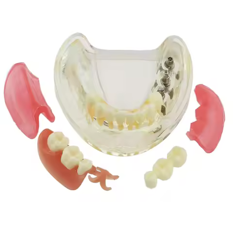 Dental Implant Teeth Model Typodont Overdenture 3 Implants M6006 Inferior Lower Bridge Restoration T