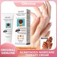 【Hot Sale】EELHOE Acanthosis Nigricans Therapy Cream Whitening Body Cream Removal Of Hyperpigmentation For Dark Body Parts like Neck Ankles Whitening Serum Dark Spot Corrector Cream Acanthosis Nigricans Therapy Cream