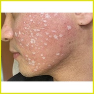 ◴ ◭ ✎ TCA Peel Solution / TCA Cross 80% 20ml for scars and tattoo removal