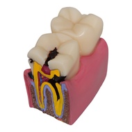 Dental Teeth model 6 Times Caries Study Denture Tooth Models Dentist Studying Researching 6 Times De