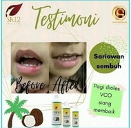 OBAT SARIAWAN MULUT DEWASA OBAT SARIAWAN DI BIBIR AMPUH DEWASA OBAT SARIAWAN UNTUK BAYI OBAT SARIAWA