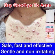 Acne Treatment Spray Removal Scar Pimple Acne Repair Oil Control Shrink Pores Moisturizing Anti Acne