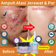 YULIN 2in1 Acne Set Azelaic Acid Serum + Sulfur Cream Effective Acne Spot Treatment for Shrinking Sc