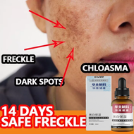 🔥Dark spot remover for face original melasma and pekas remover serum authentic retinol serum for face Effective freckle removal whitening cream anti melasma and dark spots serum melasma removal cream original niacinamide serum whitening essence 20 ml