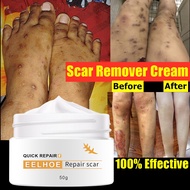 Scar Gel Acne Scars Treatment Scar Removal Cream Acne Scar Remover 50g Imports