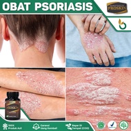 Obat Psoriasis Psoriasis Kulit Kepala Penyakit Kulit Psoriasis Psoriasis Vulgaris Psoriasis Menahun