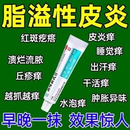 溢脂性皮炎脂溢性皮炎头部头皮红斑油腻鳞屑瘙痒异味曲咪新乳膏