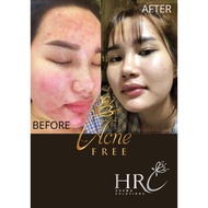 Acne Free Serum by HRC