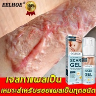 EELHOE ครีมทาแผลเป็น Gel For Scar 50ml [1 กล่อง] เจล รอยแผลเป็น รอยสิว รอยดำ รอยแดง ทาแผลเป็นนูน ลบรอยแผลเปน Scar removal cream