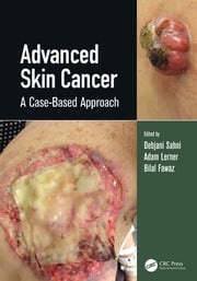 Advanced Skin Cancer Debjani Sahni