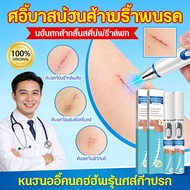 Laser pointer for scar removal, scar reduction, acne scar removal, stretch mark reduction, laser sca