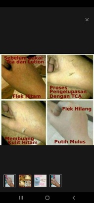 SALE TCA GEL TCA 25 peeling cream home peeling pemutih kulit badan wajah terbatas