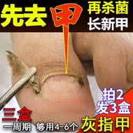 【不满意我买单】甲沟炎专用液膏去除灰指甲息i肉芽非嵌甲正甲贴矫正甲器指趾甲长到肉里 灰指甲专用