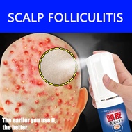 Seborrheic Dermatitis Spray 30ml Scalp Treatment Scalp Psoriasis Anti Dandruff Ubat Kulit Kepala Ber