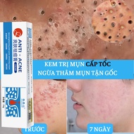 Acne whitening, moisturizing, acne removal cream, quick acne removal, skin cleansing, scar repair, p