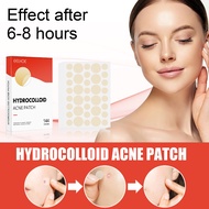 Eelhoe Acne Patch 144pcs Covering Blemishes Suitable For Acne And Acne