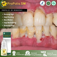 Obat Tetes Karang Gigi Plak Gigi Gigi Kuning Bau Mulut Akibat Karang Gigi Gigi Berkerak Gigi Hitam O