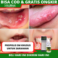Obat Sariawan - Obat Sariawan di gusi - Obat Sariawan di bibir - Obat Sariawan di lidah - Obat Saria