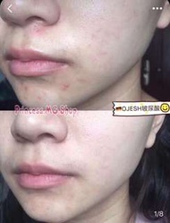 OJESH 玻尿酸精神